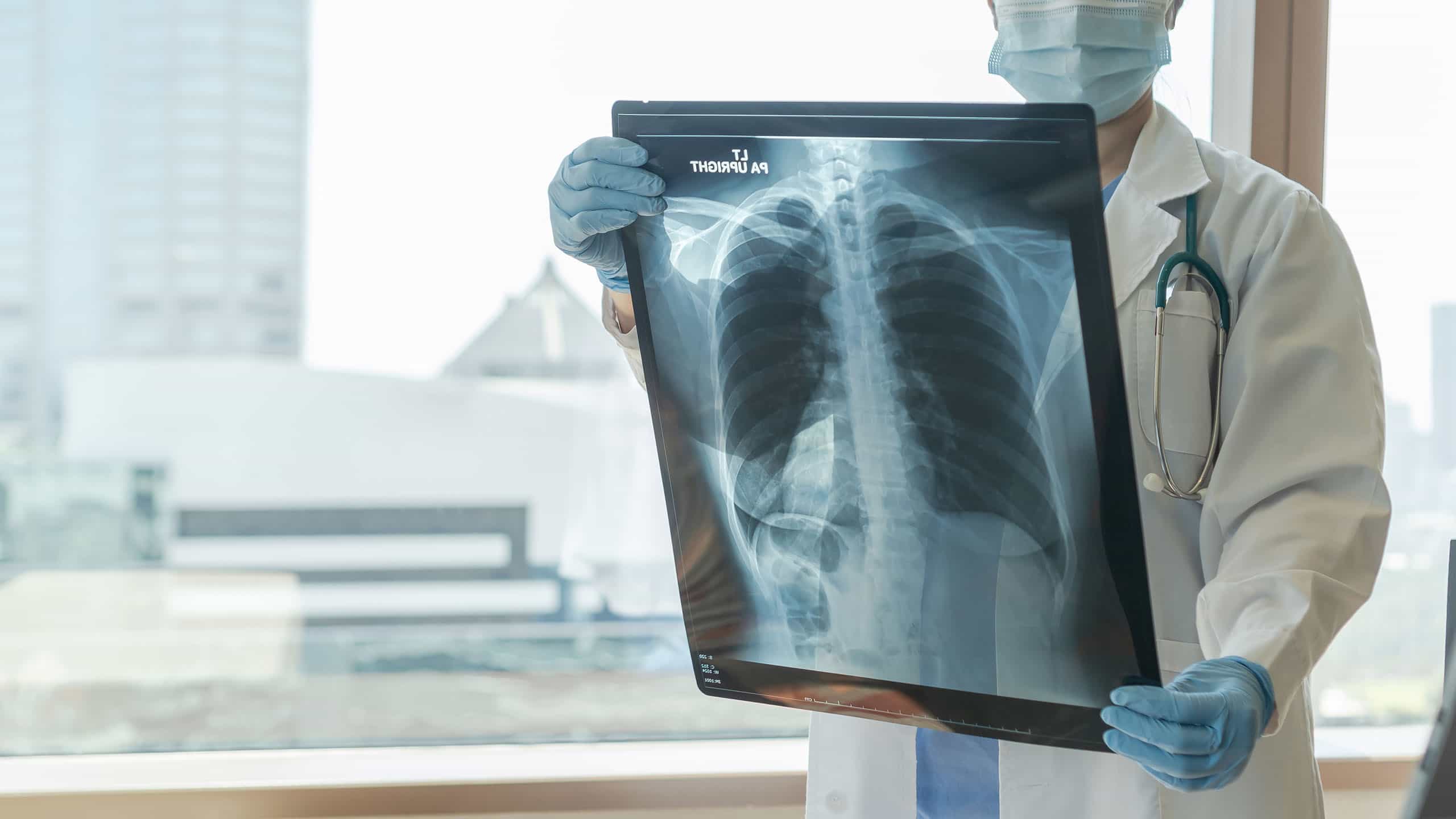 COPD: Röntgenaufnahme einer Lunge
