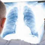 Lungenkrebs – Nicht nur Raucher:innen sind gefährdet